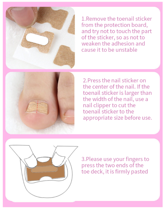Toe Align Ingrown Nail Corrector Stickers