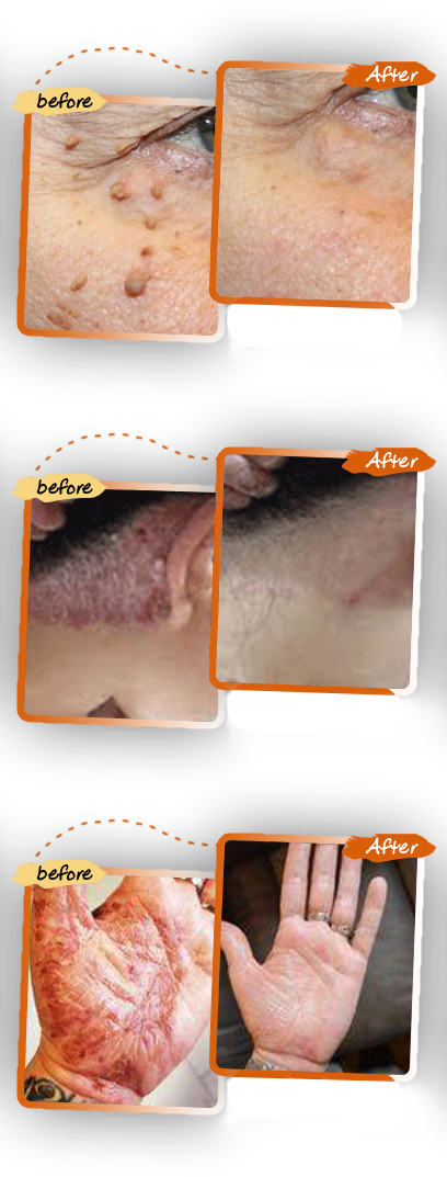 Bee Venom Mole And Wart Treatment Cream