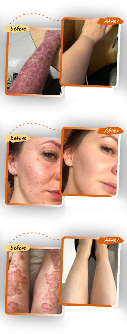 Bee Venom Mole And Wart Treatment Cream