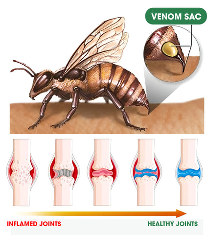 New Zealand Bee Venom Joint Bee Venom Pain And Bone Healing Cream (New Zealand Bee Extract – Specializes In Orthopedic Diseases And Arthritis Pain)