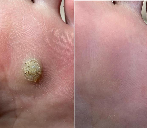 Zoe Bee Venom Mole And Wart Treatment Cream