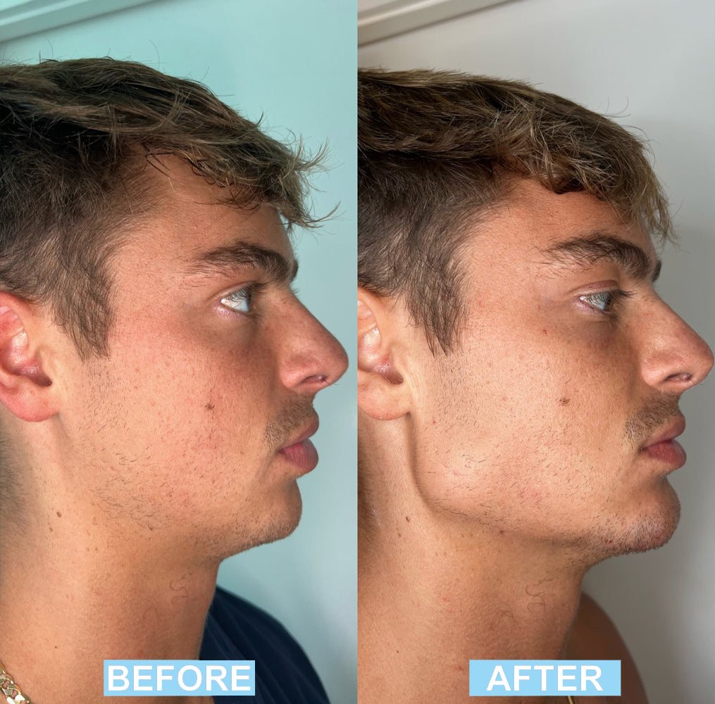 Jawline And Face Toning Exerciser