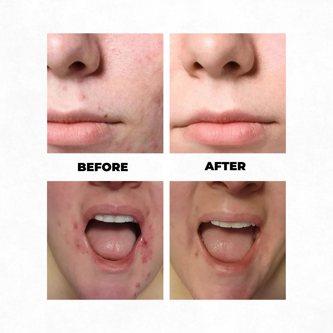 High-frequency Facial Wand V2 With Fusion Applicators (Argon + Neon)