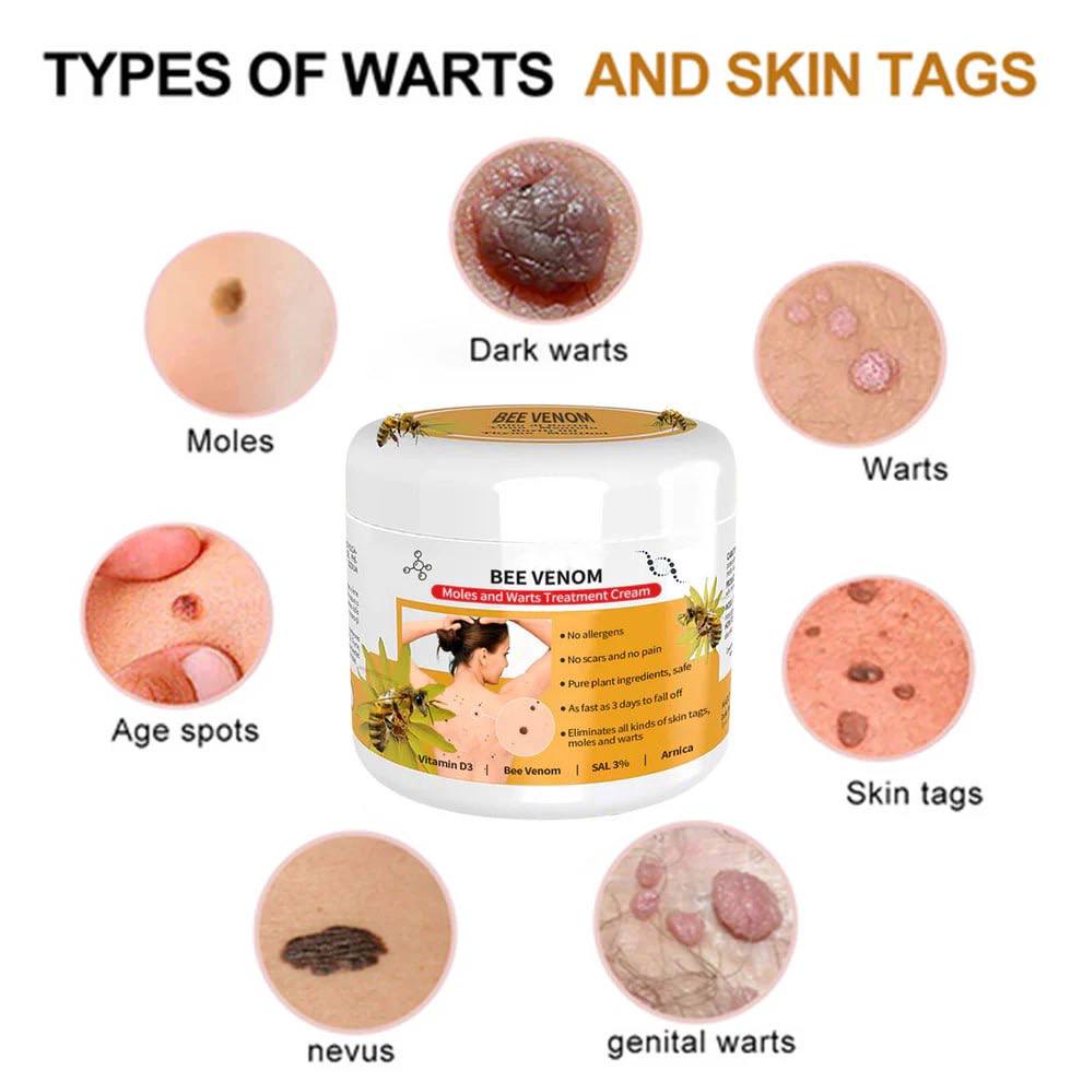 Zoe Bee Venom Mole And Wart Treatment Cream