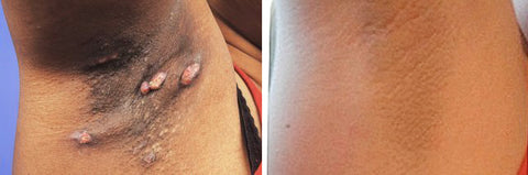 Zoe Bee Venom Mole And Wart Treatment Cream