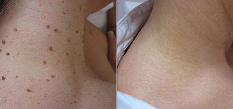 Zoe Bee Venom Mole And Wart Treatment Cream
