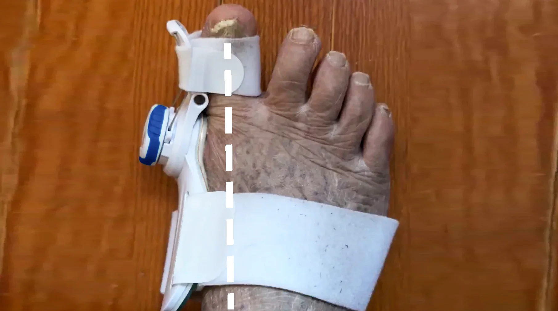 Bunionfixed