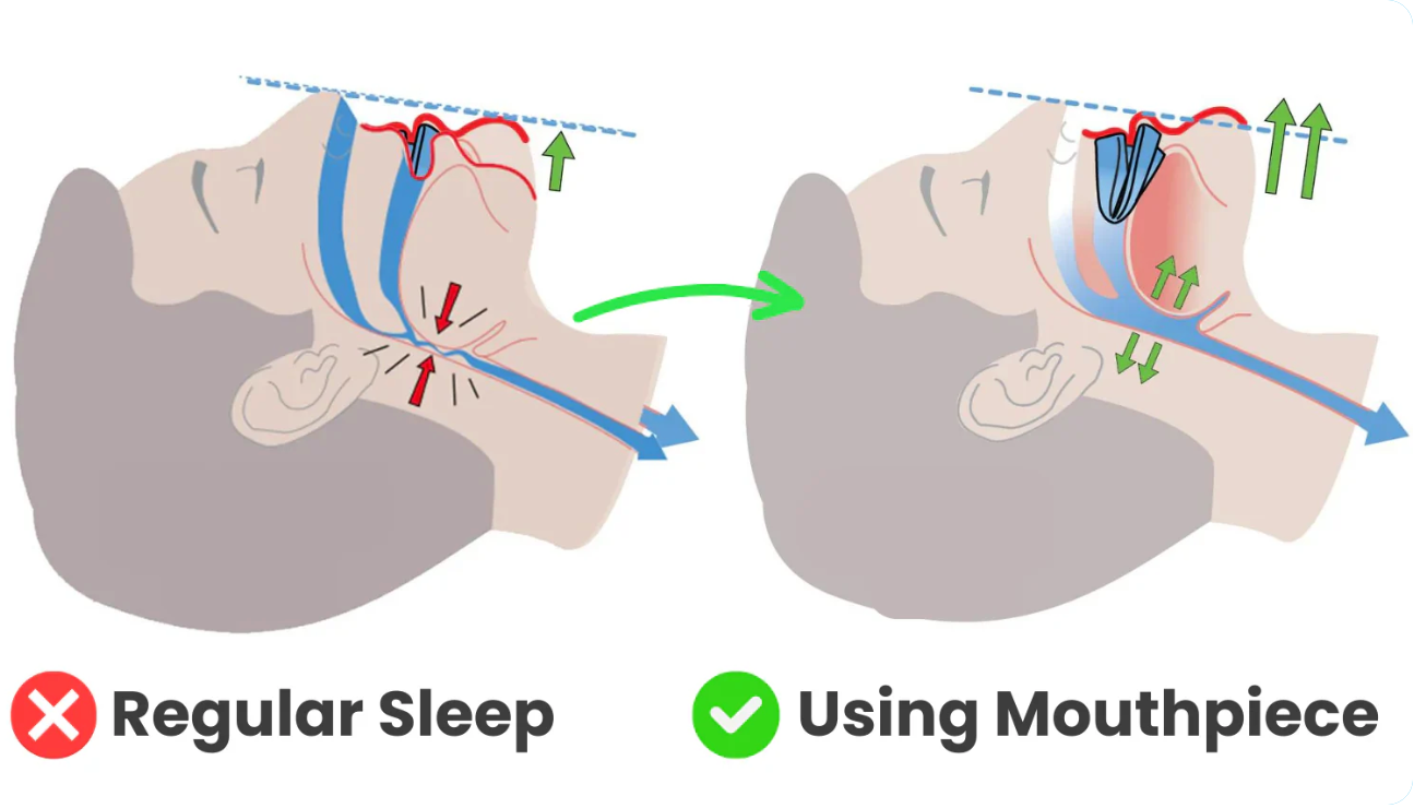 Restlab™ – Anti-snoring & Sleep-apnea