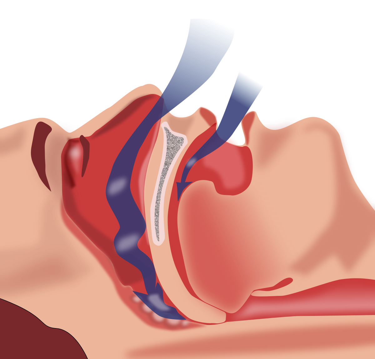 Snoreshield™ – Anti Snoring Device