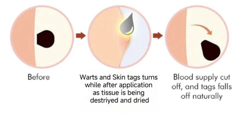 Zoe Bee Venom Mole And Wart Treatment Cream