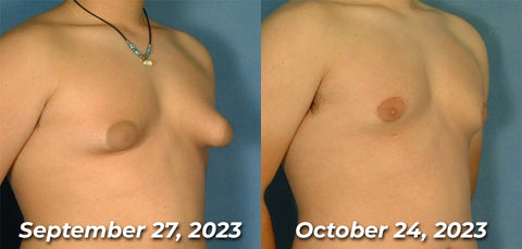 Mentherm Bee Venom Gynecomastia Heating Oil