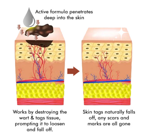 Zoe Bee Venom Mole And Wart Treatment Cream