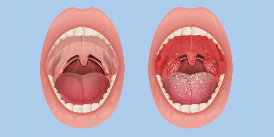 Jovina Tonsil Stone Water Flosser