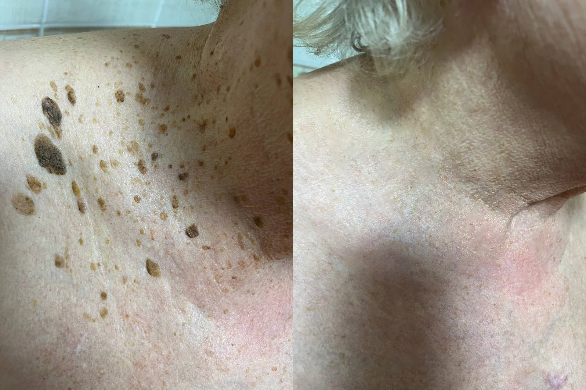 Bee Venom Treatment Cream