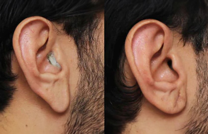 Tinniease - Silence Tinnitus Today Your Hearing Restoration Experts