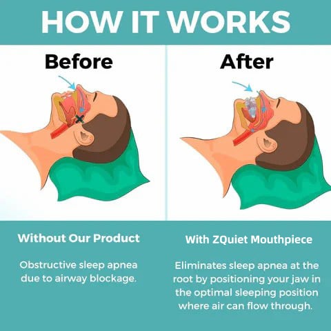 Anti Snore Mouthpiece