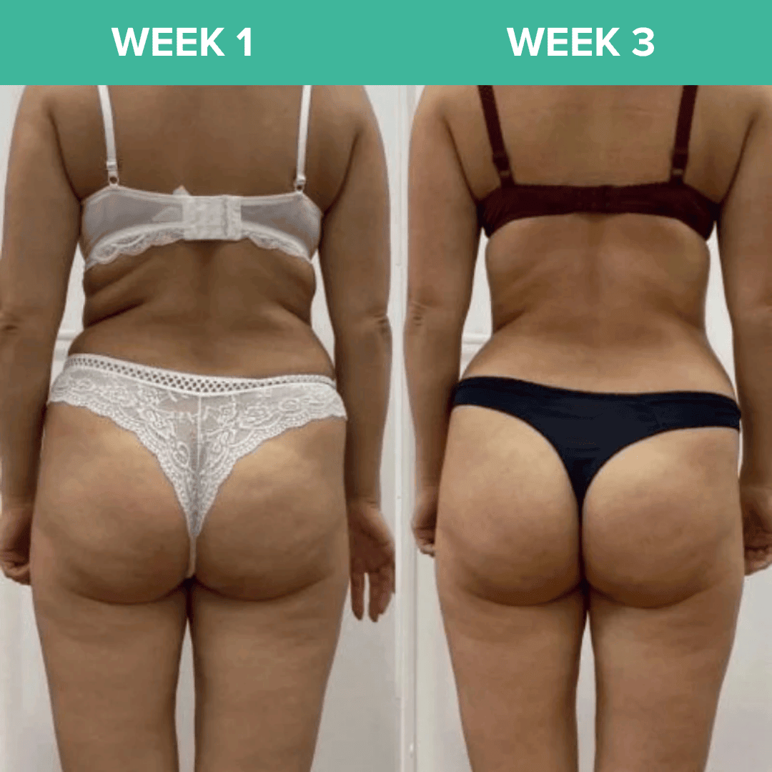 Euphranor™ : Say Goodbye To Your Cellulite Now