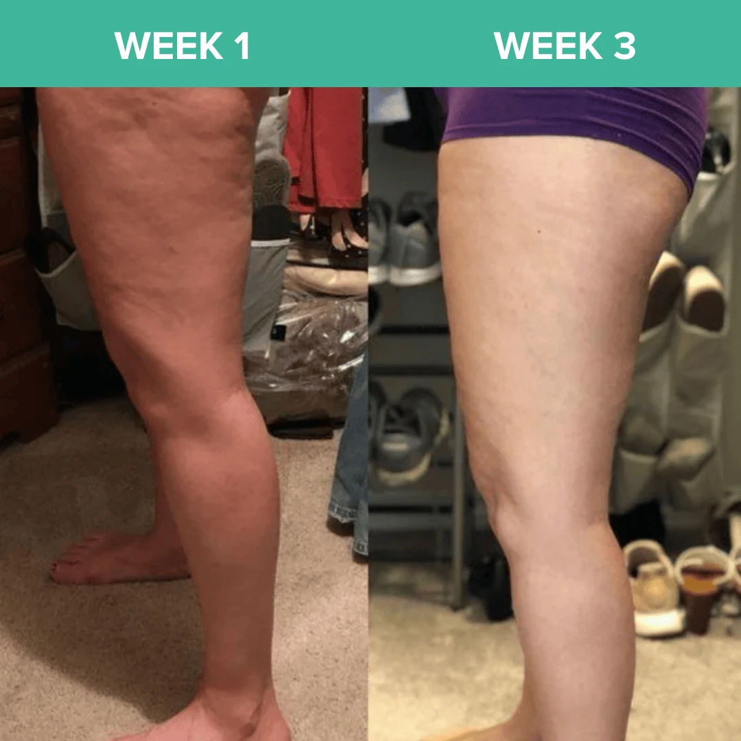 Euphranor™ : Say Goodbye To Your Cellulite Now