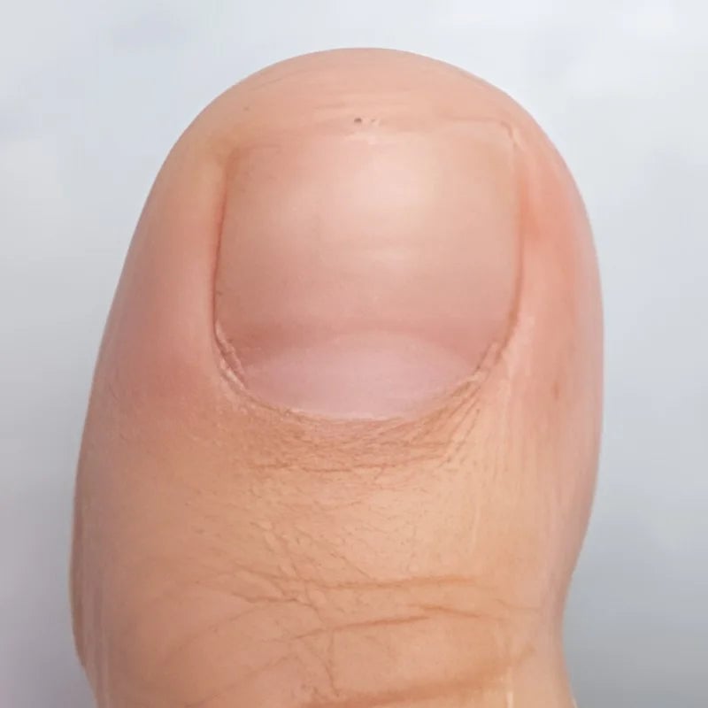 Onyclear™ – Antifungal Laser Therapy