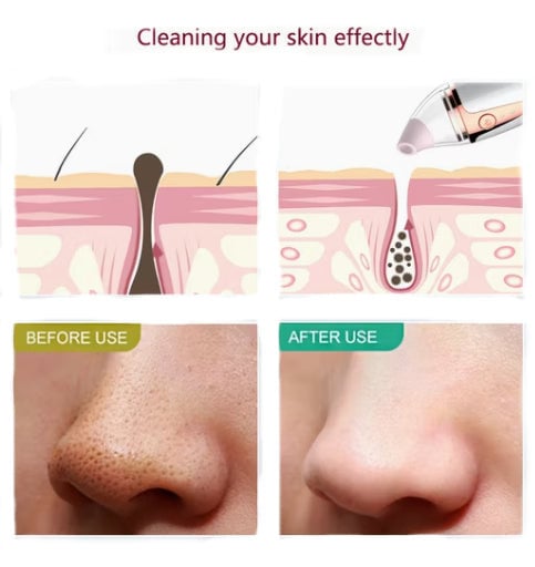 Skinova™ - Blackhead Remover Vacuum