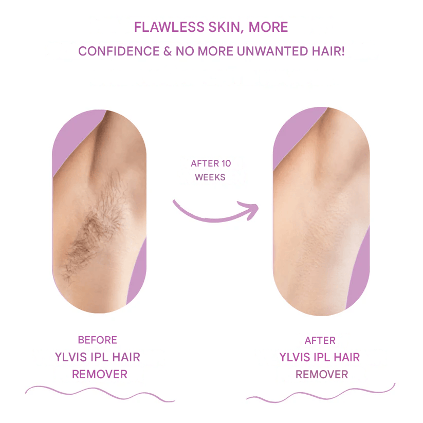 Ylvis Ipl Hair Remover