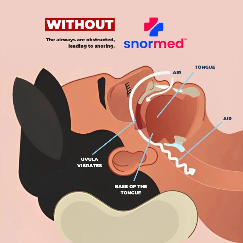 Snormed™ Pro Anti-snoring Device