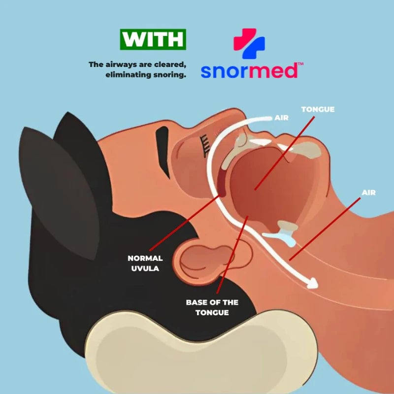 Snormed™ Pro Anti-snoring Device