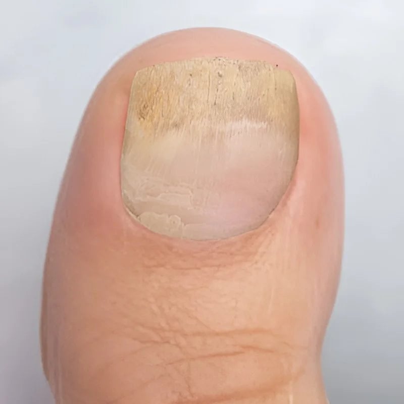 Onyclear™ – Antifungal Laser Therapy