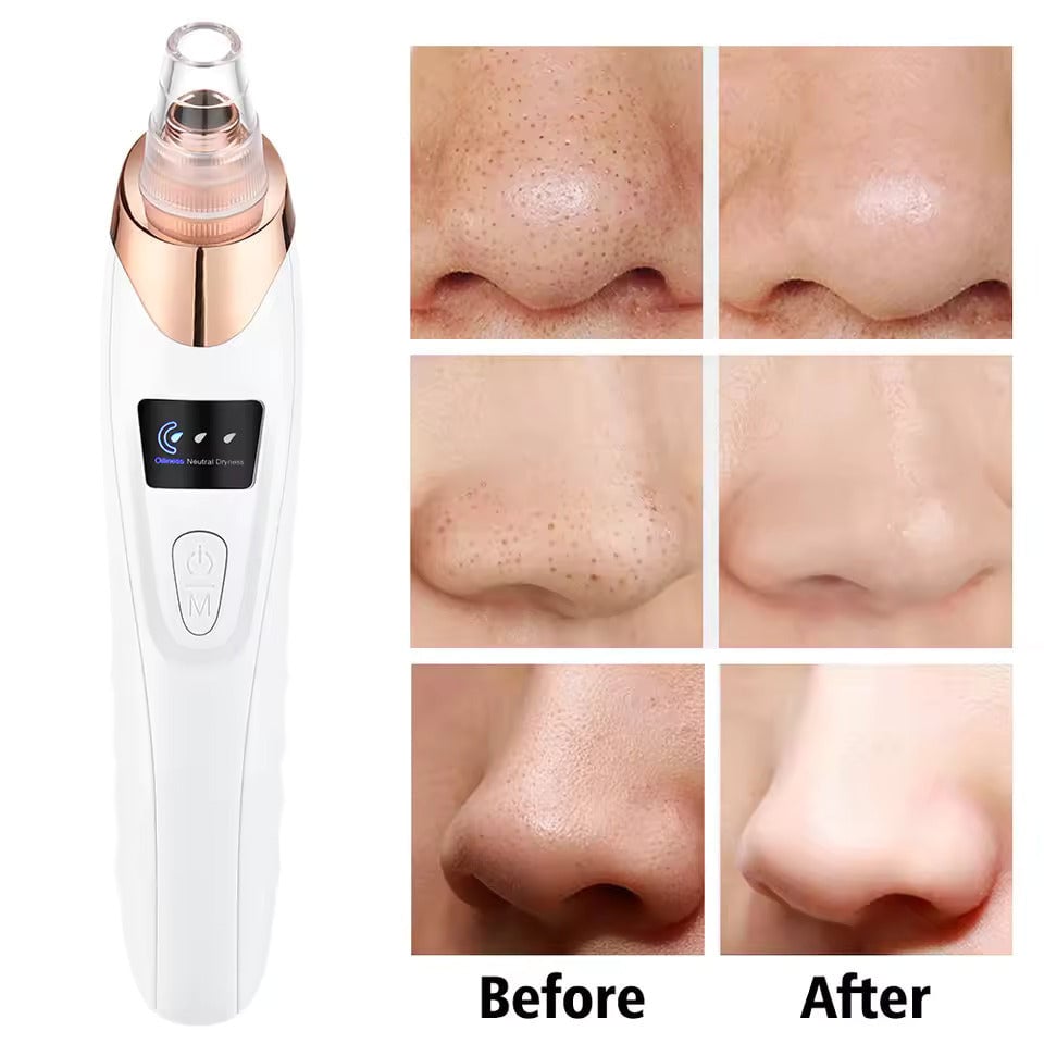 Blackhead Pore Removing Vacuum - 4fit