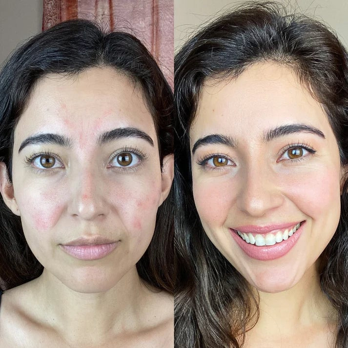 Epil Pro 3.0 Allergy-free, Pain-free Facial Hair Removal – No More Wax Or Laser