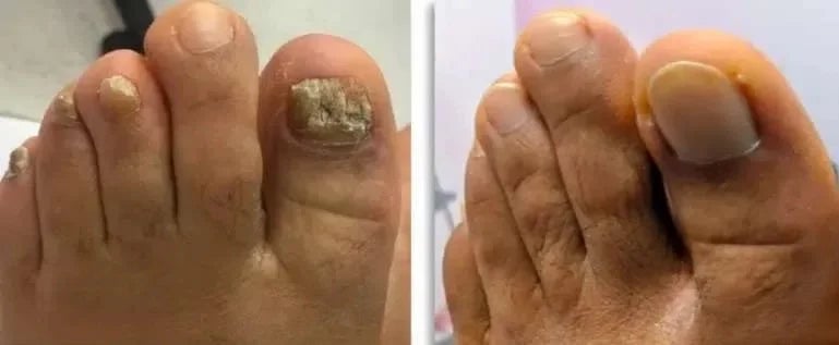 Onyclear™ – Antifungal Laser Therapy