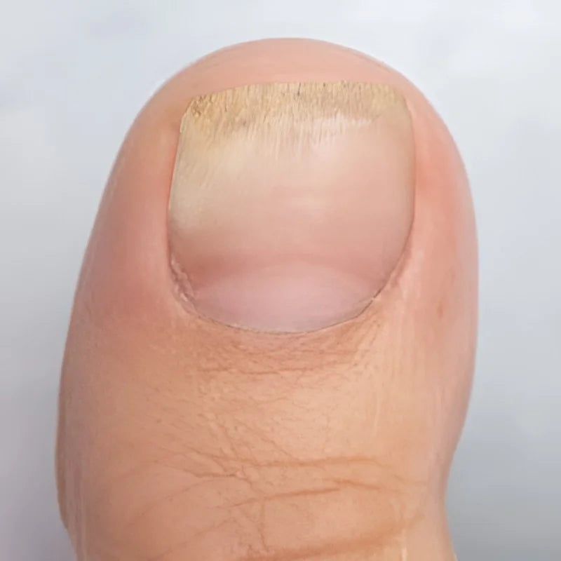 Onyclear™ – Antifungal Laser Therapy