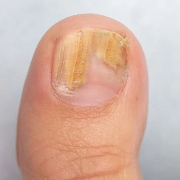 Onyclear™ – Antifungal Laser Therapy