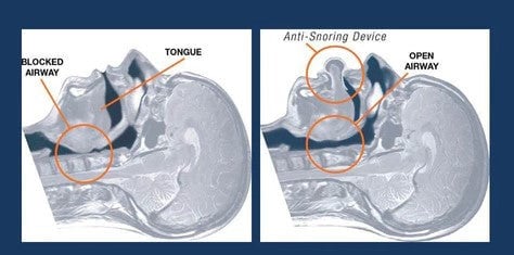 The Anti-snoring Device