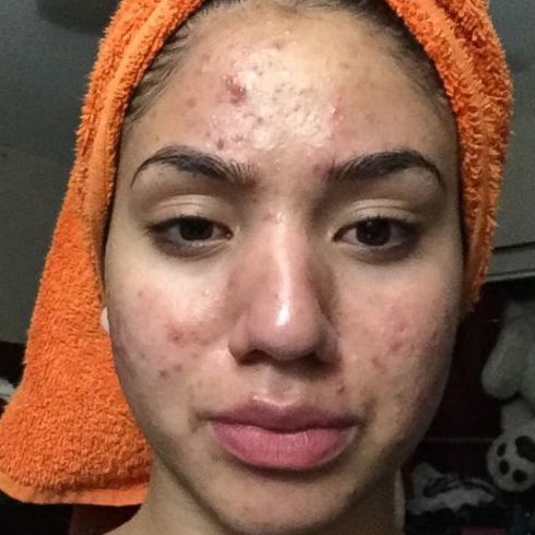 Lunexwand® Red Light Therapy