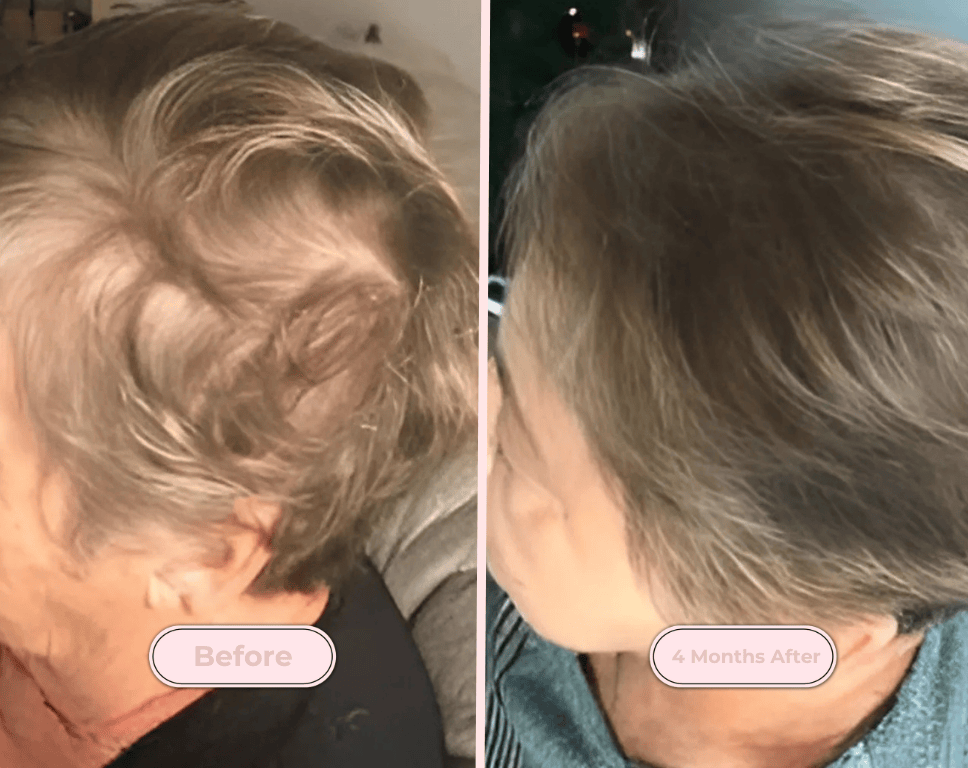 Red Light Therapy Scalp Massager