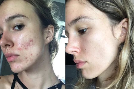 Perfelex 7-in-1 Led Facial Sculptor