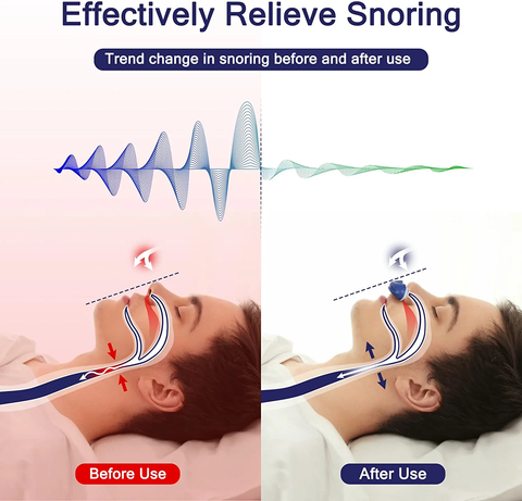 Hoseless, Maskless, Micro-cpap Anti Snoring