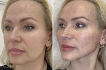 Perfelex 7-in-1 Led Facial Sculptor