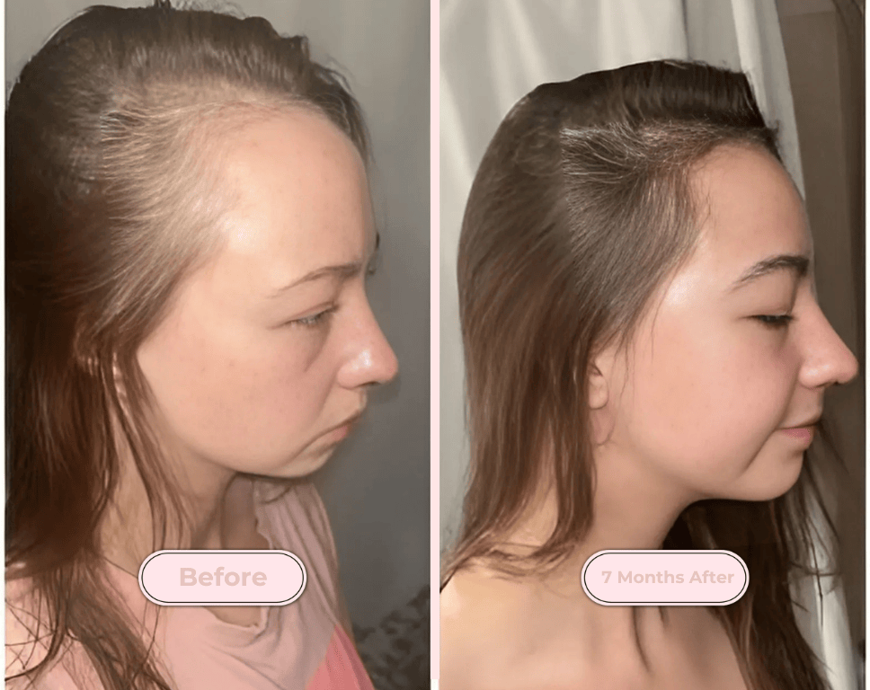 Red Light Therapy Scalp Massager