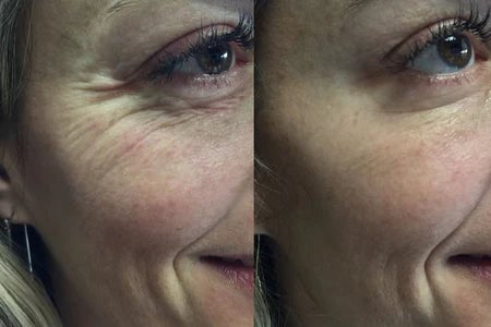 Perfelex 7-in-1 Led Facial Sculptor