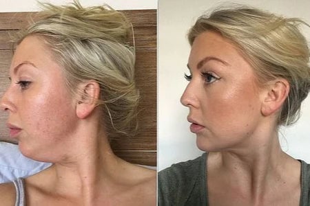 Perfelex 7-in-1 Led Facial Sculptor